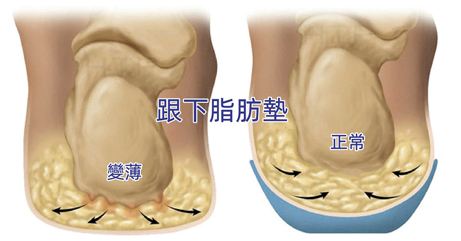 ◆脂肪墊與跟痛密切相關