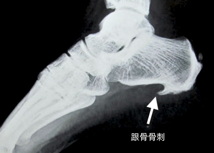 ◆跟骨骨刺和跟痛症可同時存在