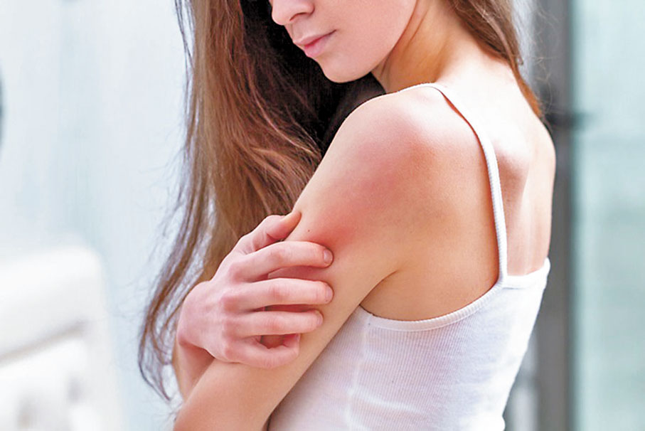 ◆濕氣困在皮膚，就會誘發濕疹蕁麻疹。