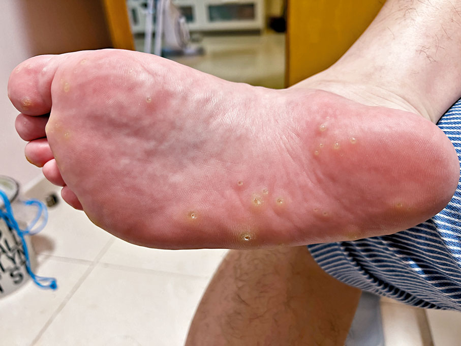 ◆羅先生腳底生出大大小小數十個病毒疣，嚴重時難以行走，「每一步都好似踩在釘子上。」