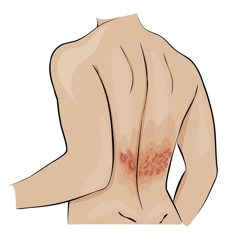 ◆春季天氣忽冷忽熱，一旦邪熱外襲，即容易誘發帶狀皰疹。