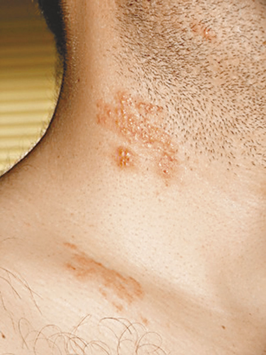 ◆帶狀皰疹好發部位主要為三叉、頸、肋間、腰骶部神經分布區。