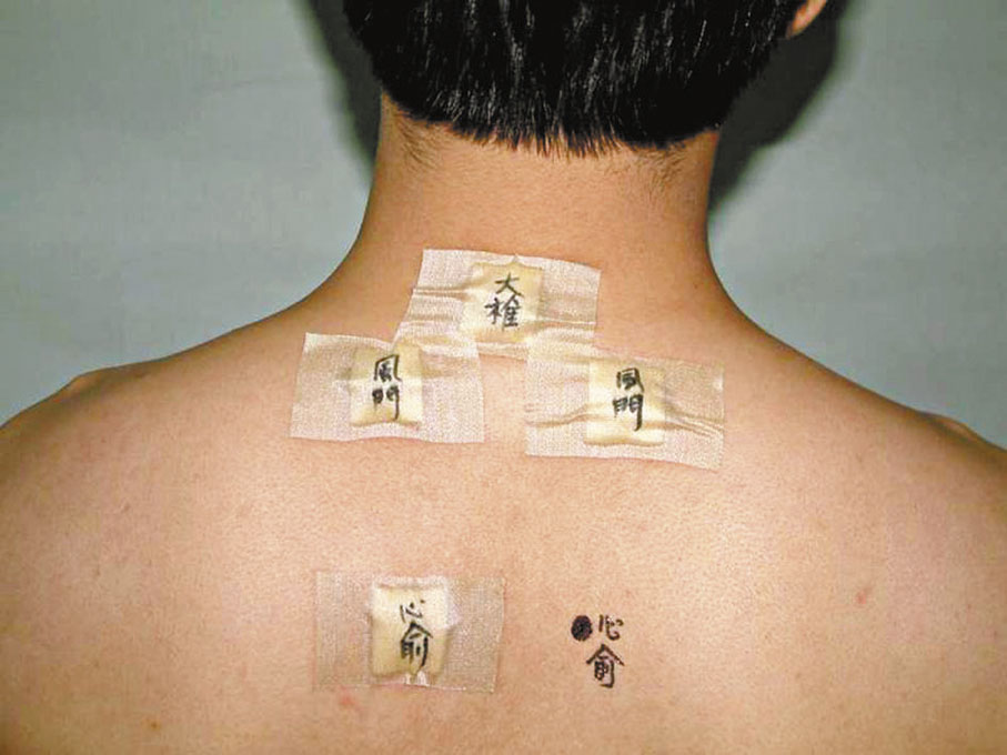 ◆「天灸療法」即在「三伏天」作穴位敷藥，對治療鼻敏感、哮喘及慢性咳嗽有顯著效用。