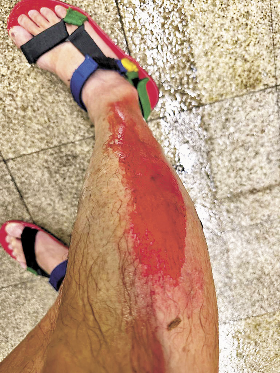 ◆鄧達智的腳受傷流血。