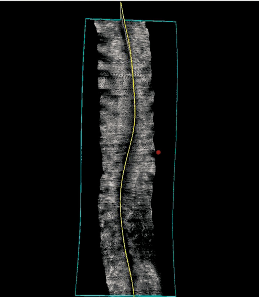 ◆3D超聲波脊柱圖像分析。