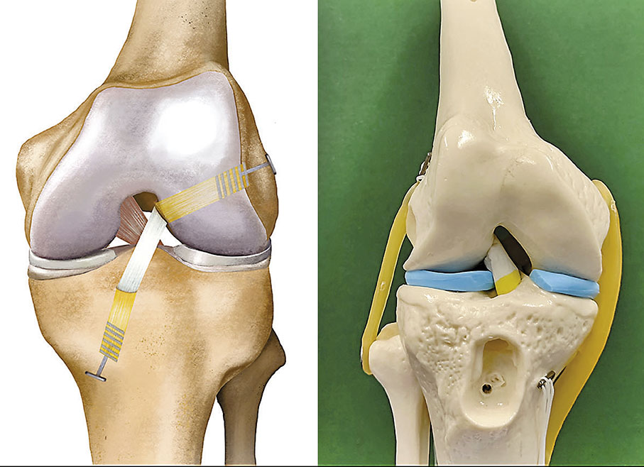 ◆「鎂縵生科」可再生人工韌帶產品及應用示例。 受訪者供圖