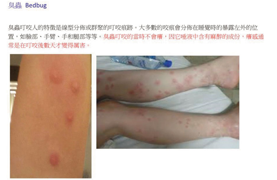 ◆床蝨一般於晚上由藏身處爬出，叮咬人類裸露在外的皮膚。