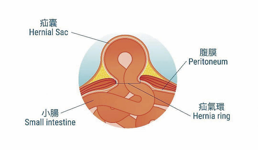◆小腸氣示意圖