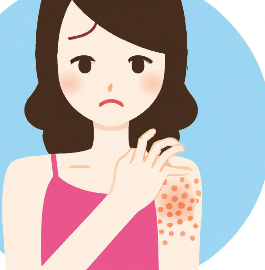 ◆濕疹的主要特徵是痕癢性皮疹。