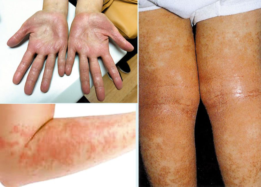 濕疹分布位置有一定的規律性