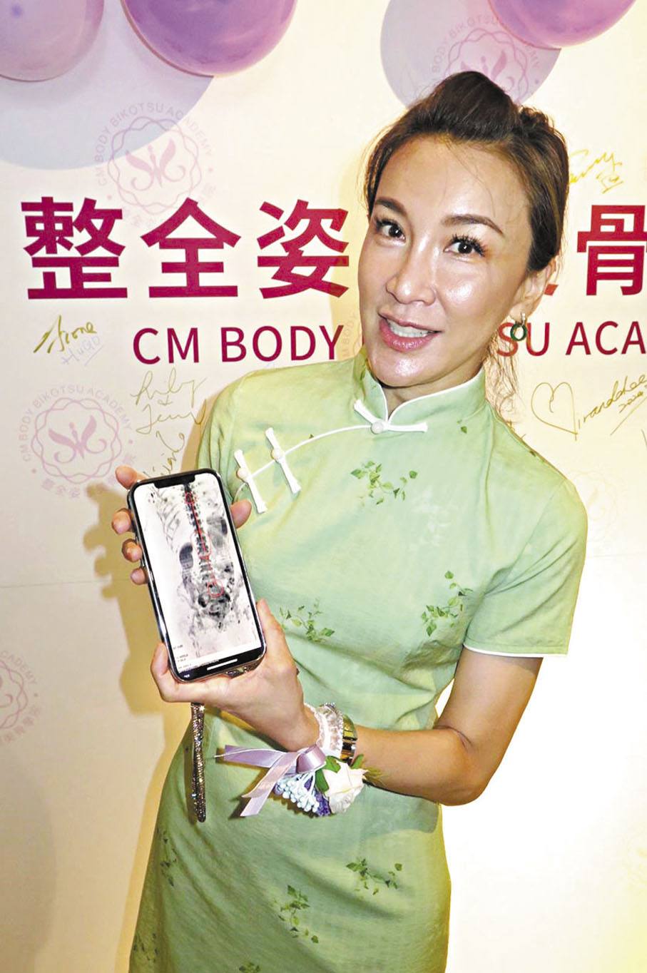 ◆李思林以X光照展示其脊椎側彎的情況。