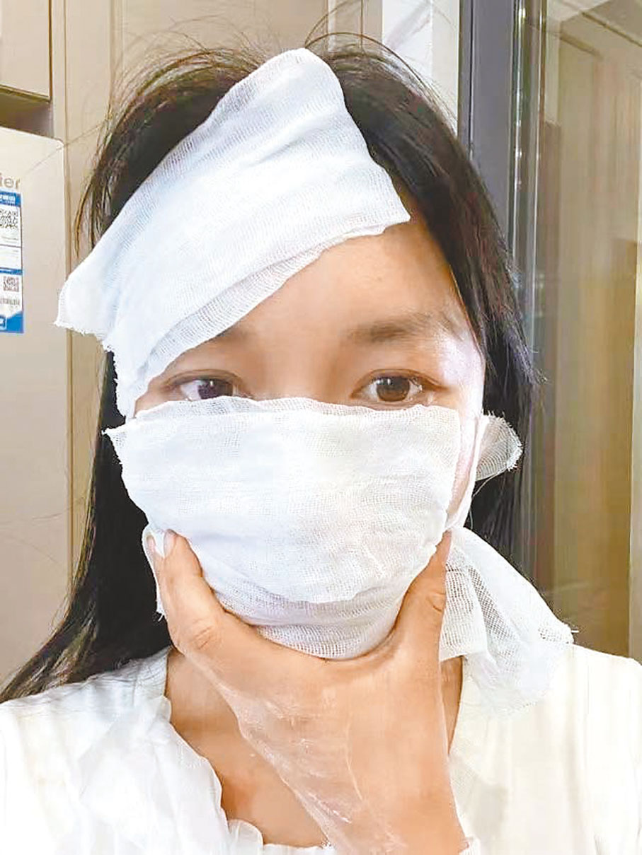 ●李子柒早前自曝因學習漆藝，導致全身過敏。 網絡圖片