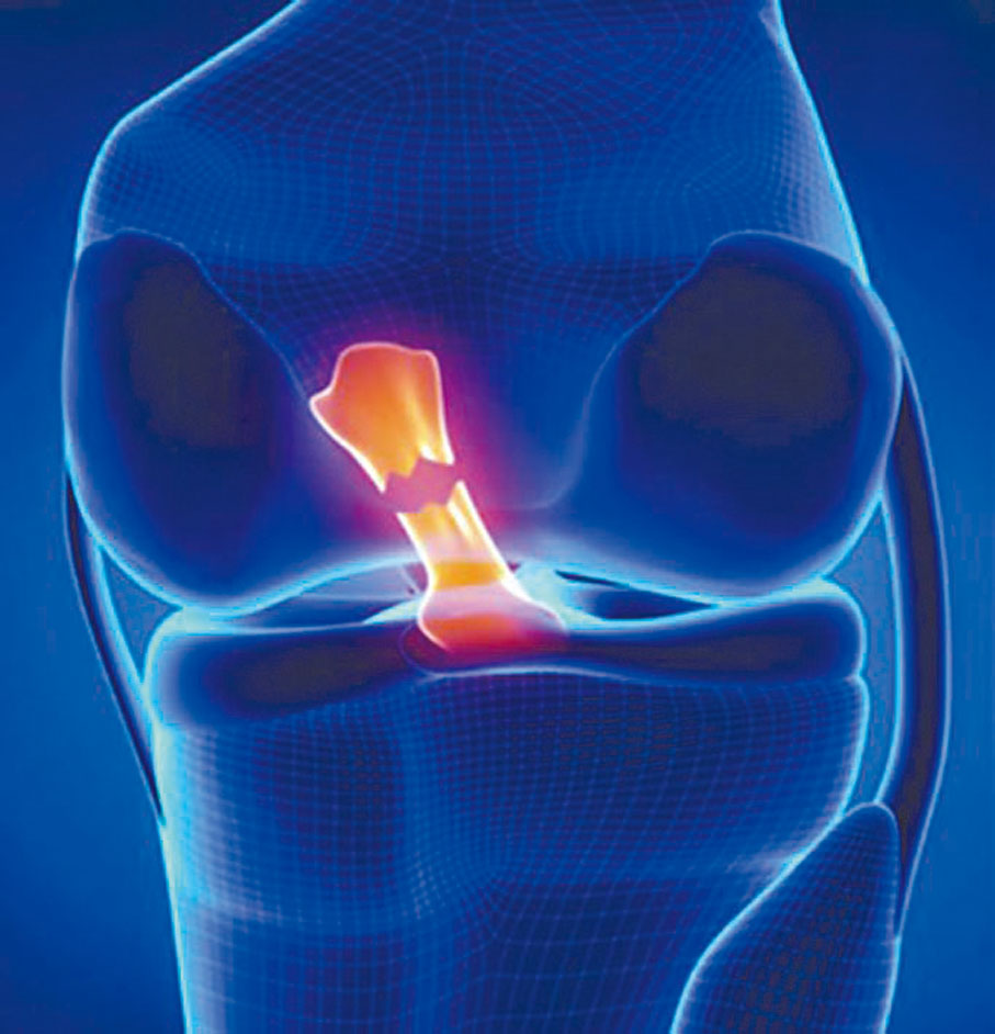 ●容樹恒領導的中大團隊，針對運動員不時出現的十字韌帶重建手建，研發多項創新方案。 資料圖片