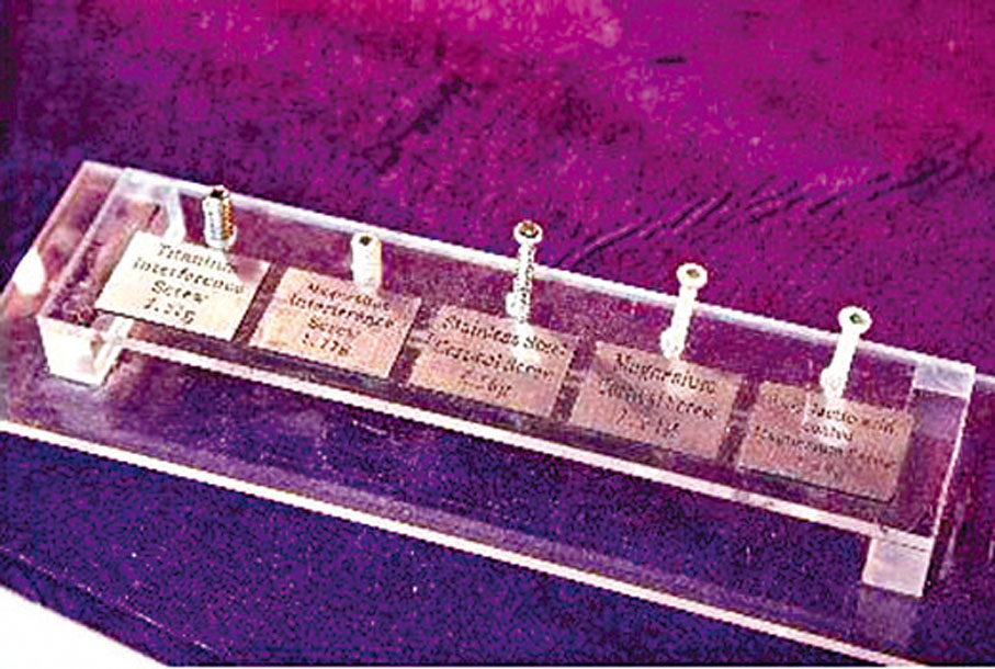 ●以先進生物材料製造的螺釘及鎂線能夠加快受損組織的癒合，提升穩定性。 中大圖片