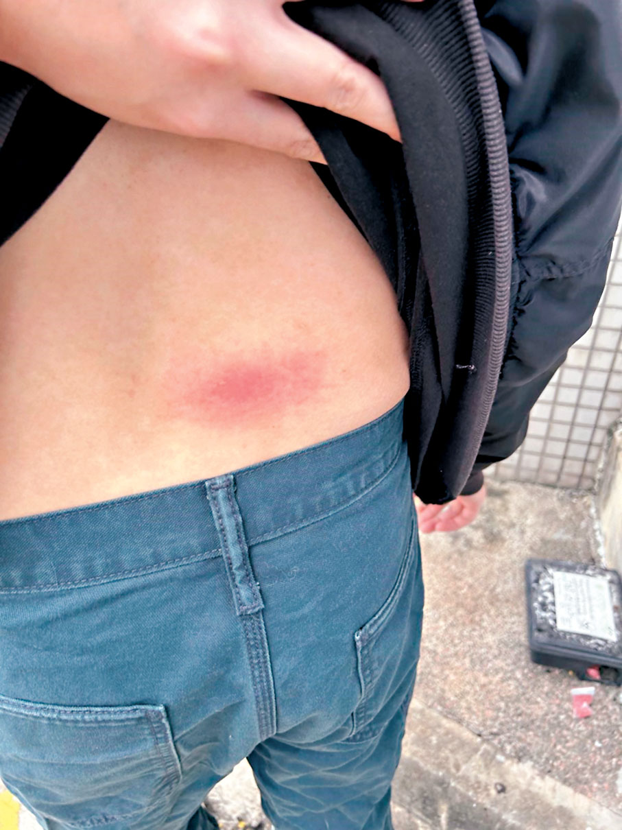●李小姐的男友疑遭「惡鄰居」一拳擊中腰部,留下紅腫一片。 受訪者提供