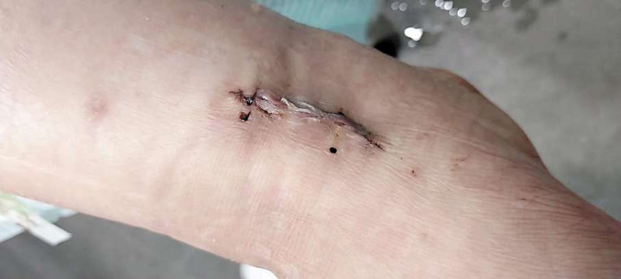 ●有居民路經破損路面導致腳部受傷要入院縫針。