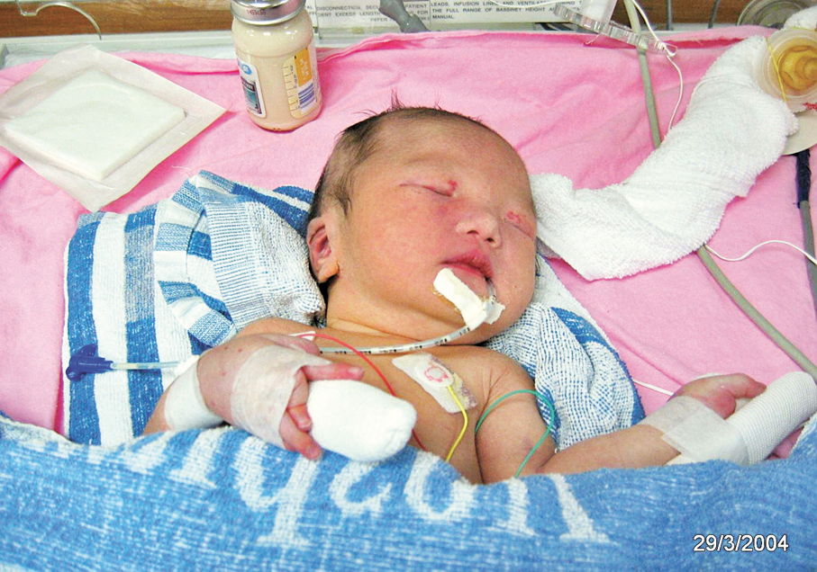 ● 王愉程出世便患有「先天性結締組織異常」，肌肉天生無力。 受訪者供圖