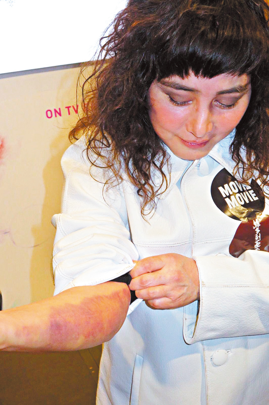 ●何超儀展示手臂的瘀痕。  香港文匯報記者阿祖 攝