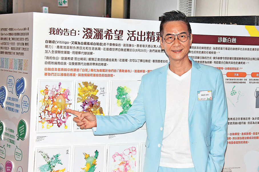 ●陳啟泰大方分享患白蝕的心路歷程。香港文匯報記者達里  攝
